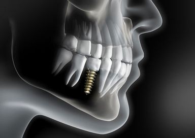 Röntgenbild von Gebiss mit Implantat in Birgitz im Bezirk Innsbruck Land